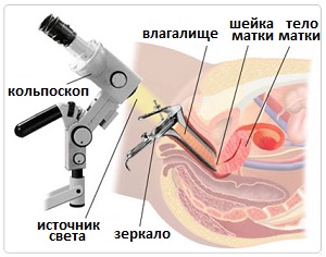 кольпоскопия при раке шейки матки