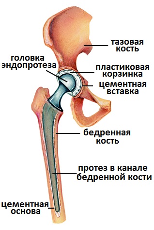 эндопротезирование тазобедренного сустава