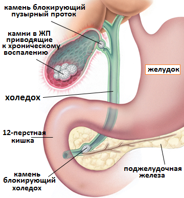 острый холецистит причина