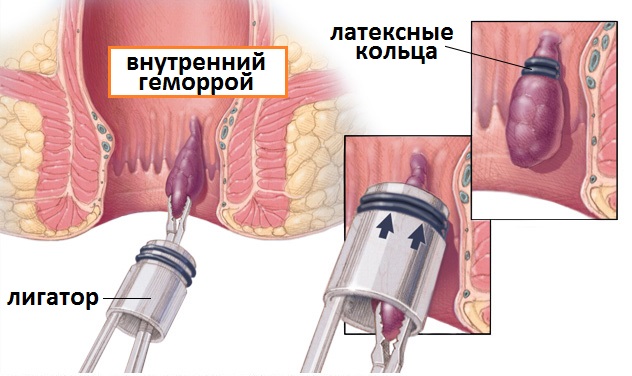 лигирование геморроидальных узлов кольцами