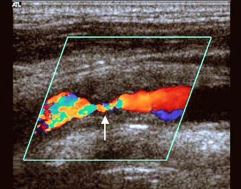узи внутренней сонной артерии при критическом стенозе