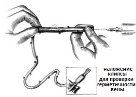 подготовка вены для аортокоронарного шунтирования