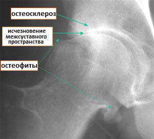 остеоартроз тазобедренного сустава