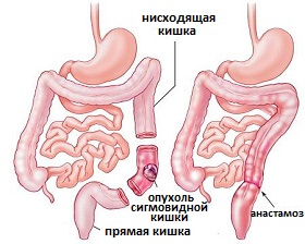 операция резекции сигмовидной кишки при раке