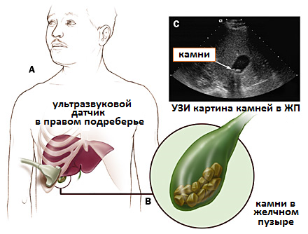 узи желчного пузыря