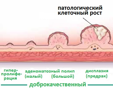 доброкачественный полип толстой кишки
