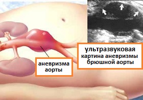продольный срез при УЗИ брюшной аневризмы