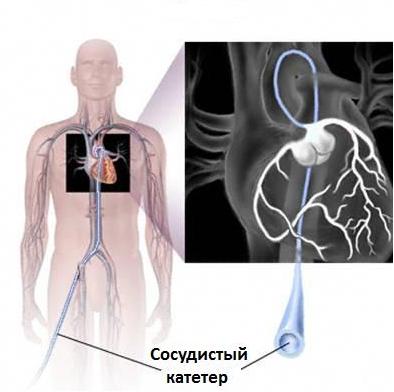 коронарография