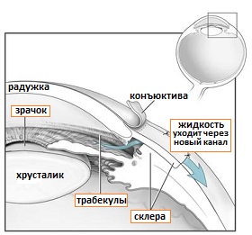 операция трабекулэктомия при глаукоме