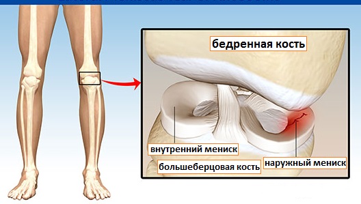 травма мениска