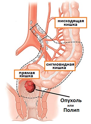 резекция прямой и сигмовидной кишки