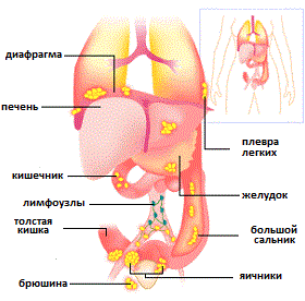 рак яичников 4 стадии