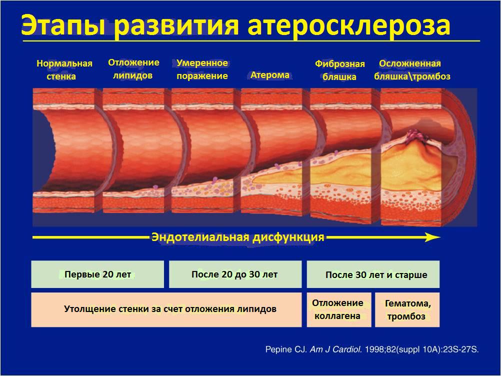 этапы развития атеросклероза