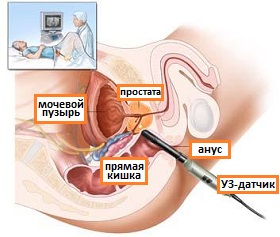 трансрекатльное узи простаты
