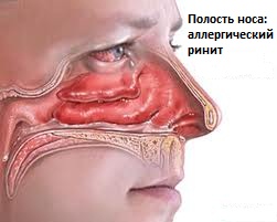 аллергический ринит
