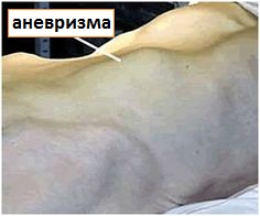вид аневризмы через брюшную стенку