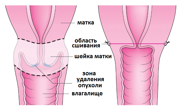 радикальная трахелэктомия