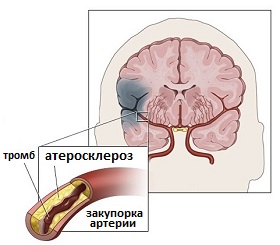 ишемический инсульт