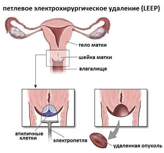 leep операция