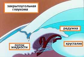 закрытоугольная глаукома