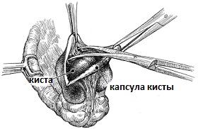 операция удаления кисты яичника
