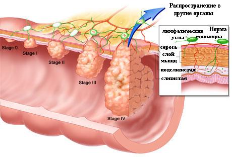 стадии рака толстой кишки и классификация