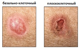 базально-клеточный и плоскоклеточный рак кожи
