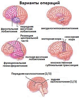 операции для лечения эпилепсии