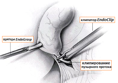 лапароскопическая холецистэктомия: этап клипирования пузырного протока