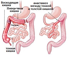 правосторонняя гемиколэктомия