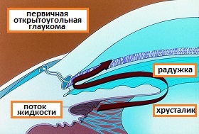 первичная открытоугольная глаукома