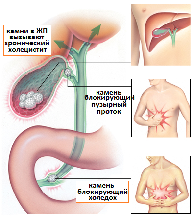 симптомы холецистита