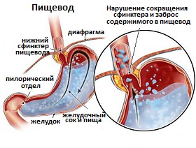 рефлюкс из желудка в пищевод