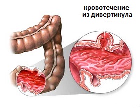 кровотечение при дивертикулезе