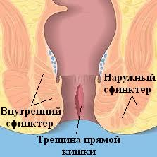 анальная трещина