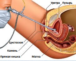 цистоскопия мочевого пузыря