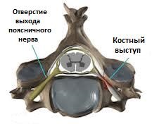 корешковый синдром