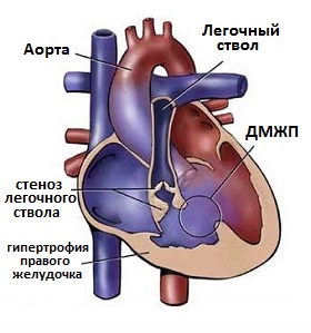 тетрада Фалло
