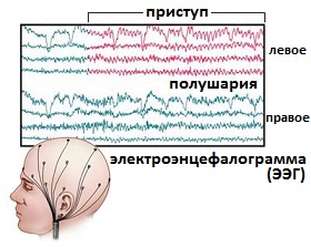 электроэнцефалограмма