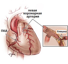 причины ишемической болезни сердца