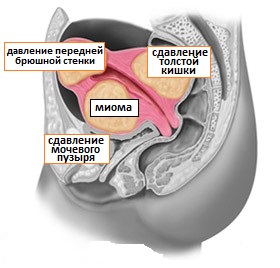 миомы матки до эмболизации маточных артерий