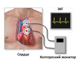 холтеровское мониторирование