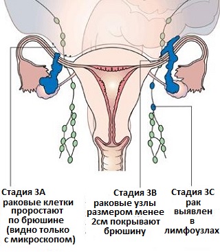 классификация рака яичников - 3 стадия