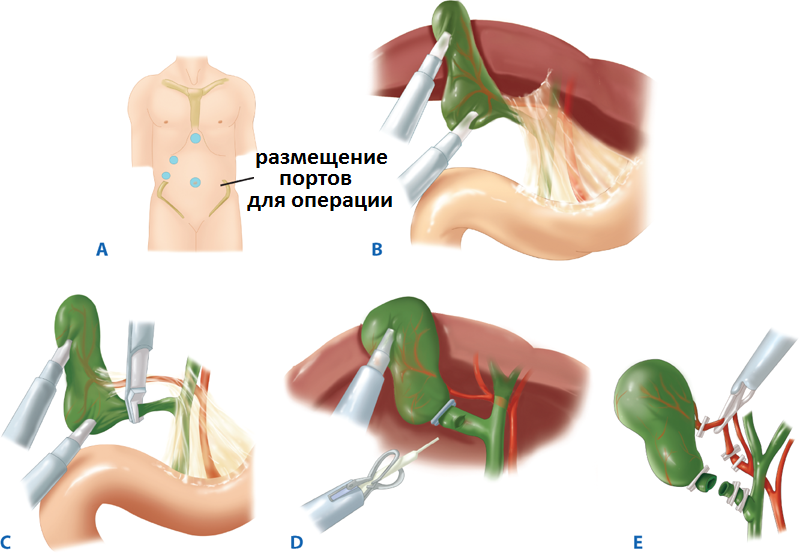 ход лапароскопической холецистэктомии
