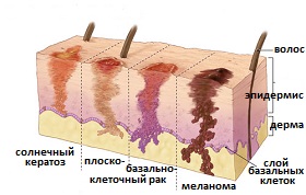 виды рака кожи
