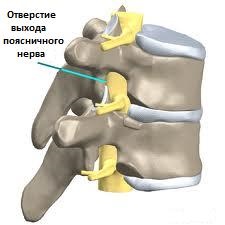радикулопатия