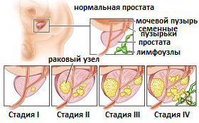 классификация рака простаты