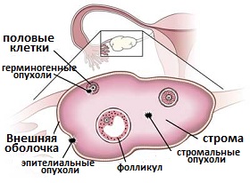 происхождение и причины рака яичников