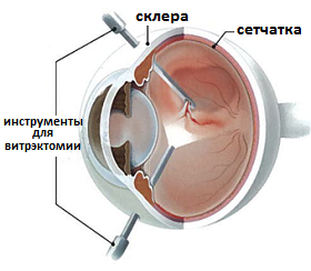 операция витрэктомии