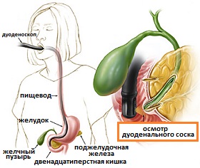эзофагогастродуоденоскопия с осмотром дуоденального сосочка